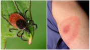 Tick ​​Borreliosis