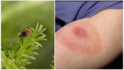 Tick ​​Borreliosis
