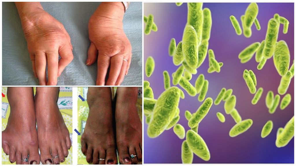 May sakit na brucellosis sa mga tao