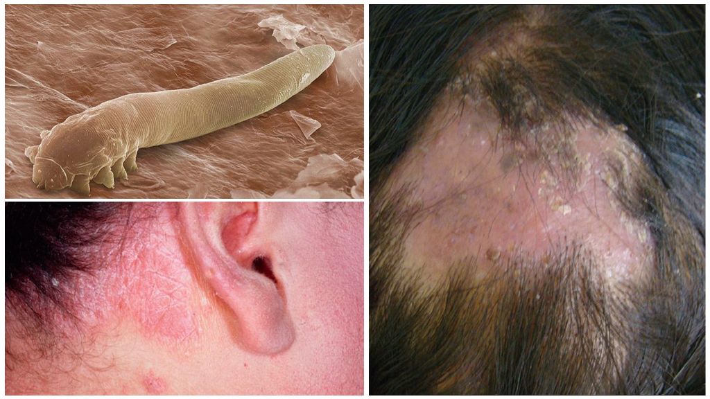 Symptomer og behandling af demodicosis i hovedbunden