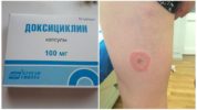 Doxycycline na may Borreliosis