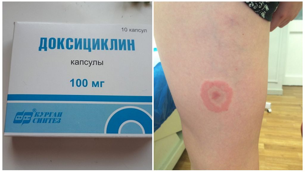 Doxycyclin til forebyggelse og behandling af borreliose