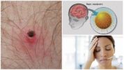 Encefalitis transmesa per tick