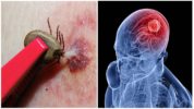 Tick-båret viral encephalitis