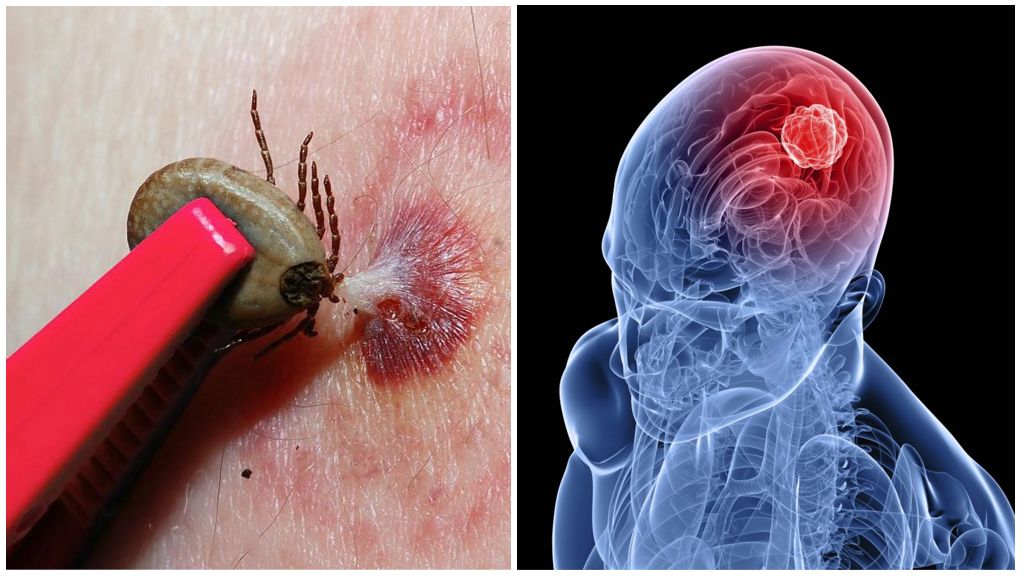 Huidige SanPiN voor door teken overgedragen encefalitis