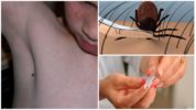 Rimozione di un segno di spunta dal corpo