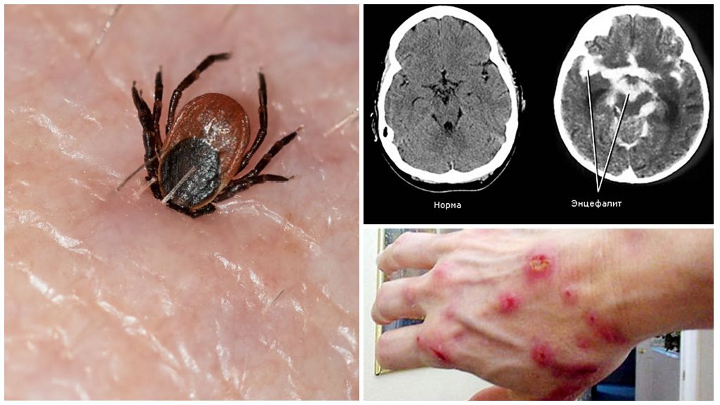 Door teken overgedragen encefalitis en borreliose
