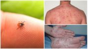 Pinahihintulutan at maibalik ang typhus-typ typho typhus