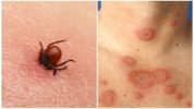 Lyme sygdom