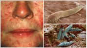Demodex facial tik