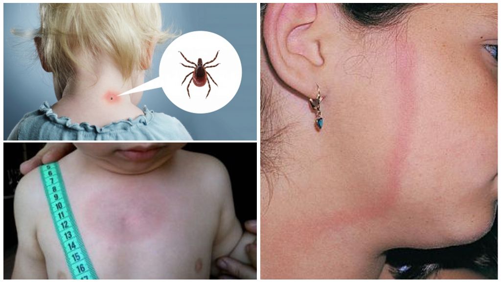 Symptomen en behandeling van door teken overgedragen borreliose bij kinderen