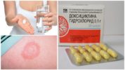 Doxycycline na may Borreliosis
