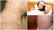 Mga epekto ng pagbabakuna ng tularemia