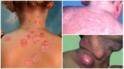 Tularemia