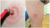 Tick ​​Borreliosis