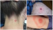 Tick ​​Borreliosis