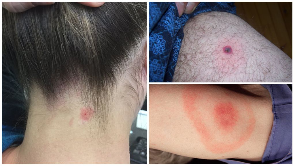 Hvordan borreliose overføres - Lyme sygdom