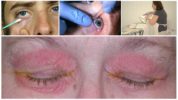 Paggamot ng eyelid demodicosis