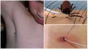 Mètodes d’extracció de tick