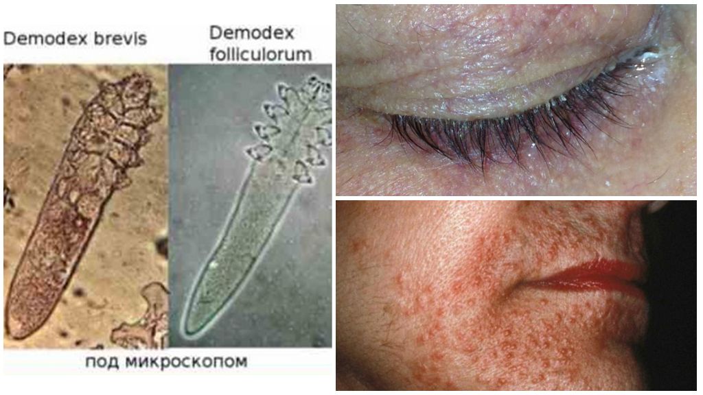 Larawan, paglalarawan at paggamot ng balat mite Demodex