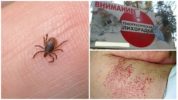 Febbre emorragica trasmessa da zecche